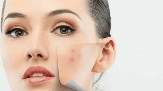 Pimple Menace: Simple & Effective Tips To Prevent Acne! - BonAyu Health