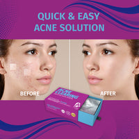 ACNE CLEARING STRIPS -Salicylic acid strips
