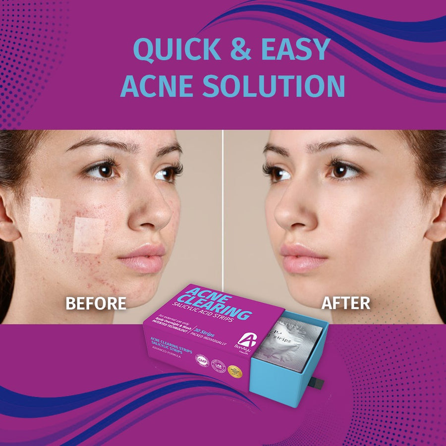 BonAiyu Acne Pimple Patch Removable Strips/Stickers For Men And Women With Salicylic Acid